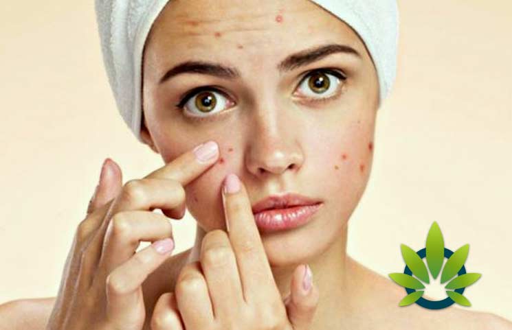 cbd for acne